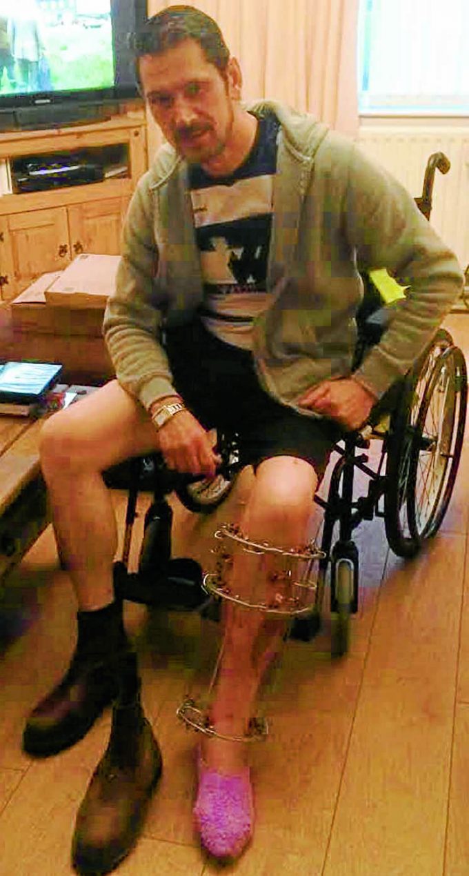 GETTING BETTER . . . Malcolm has been using a wheelchair and wearing a cage on his leg as a result of the damage