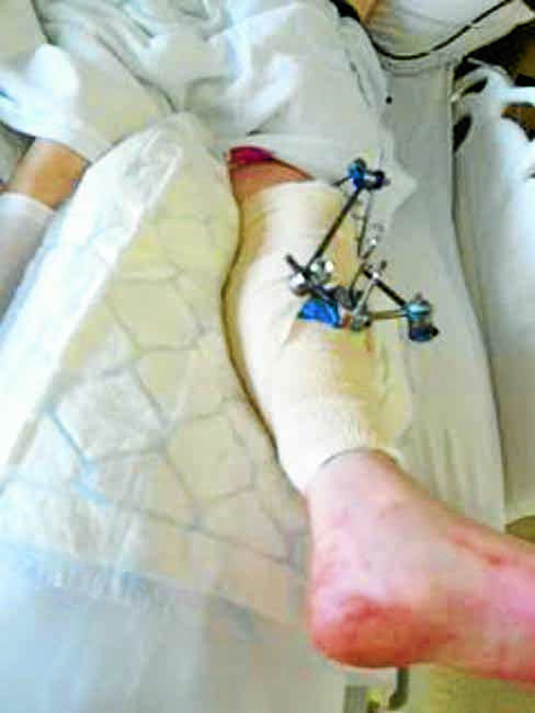 TRACTION . . . the injuries resulted in a month's stay in hospital and four operations